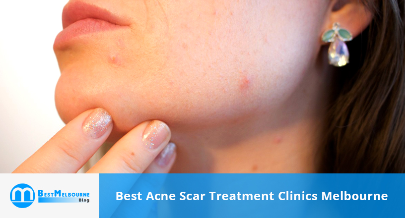 Acne Scar Treatment Clinics Melbourne