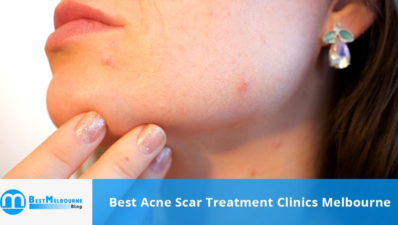 Best dating with acne scars treatment 2022